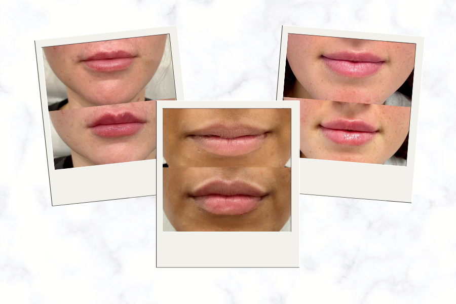 Lip Fillers For Beginners Your Biggest Questions Answered 